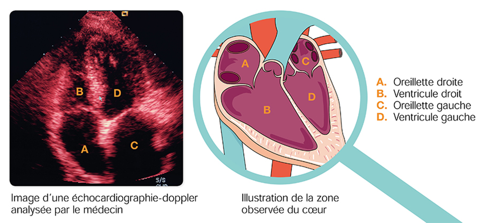 Image d'une échocardiographie-doppler analysée par le médecin & illustwration de la zone observée du coeur